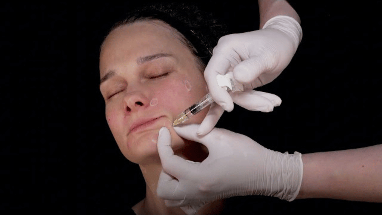 INNEA AQUA and EVIDENCE Biorevitalization by Aesthetic Points of the Face